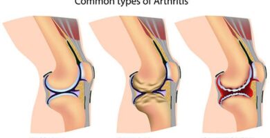 Understanding Juvenile Arthritis: An Overview