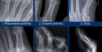 The X-rays of Arthritis